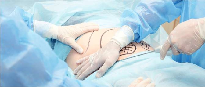 Endoscopic abdominoplasty