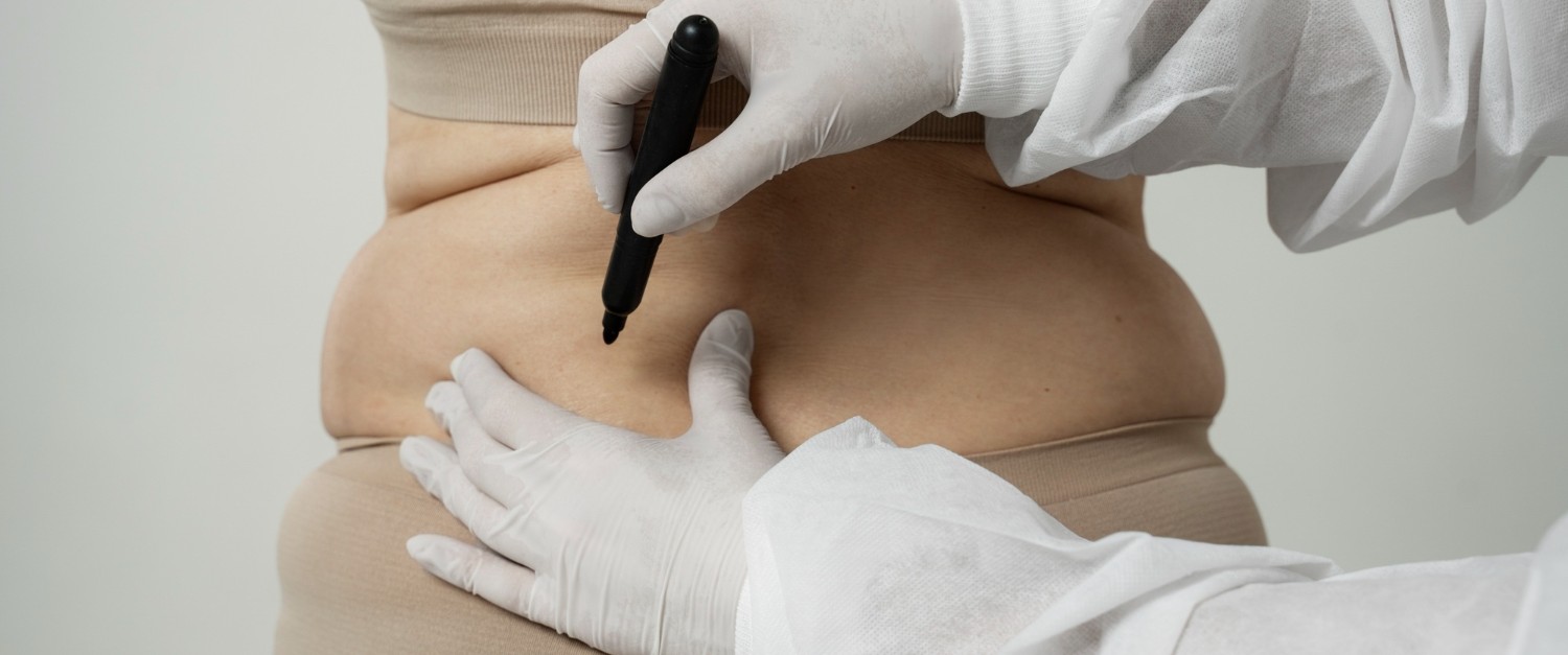 Back Fat Removal Surgery Procedure and Benefits
