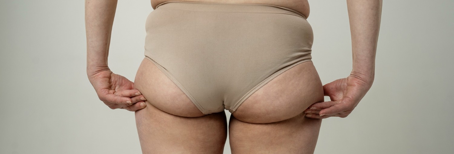 Buttock Liposuction Reduction Procedure & Recovery A Complete Guide