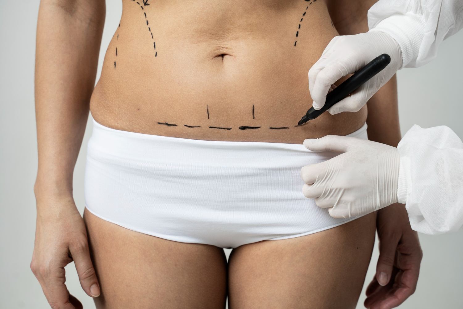 Which Liposuction Methods Are Best for Sculpting the Body?