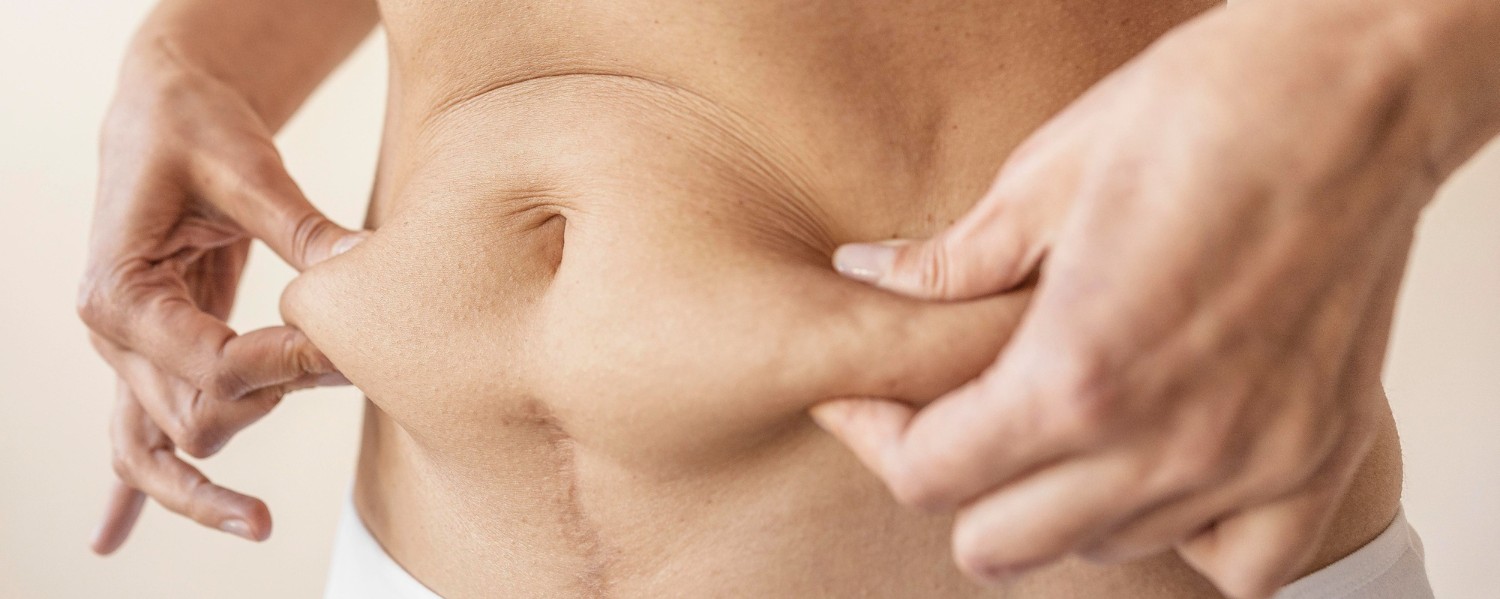 A Guide To Liposuction Surgery in Dubai