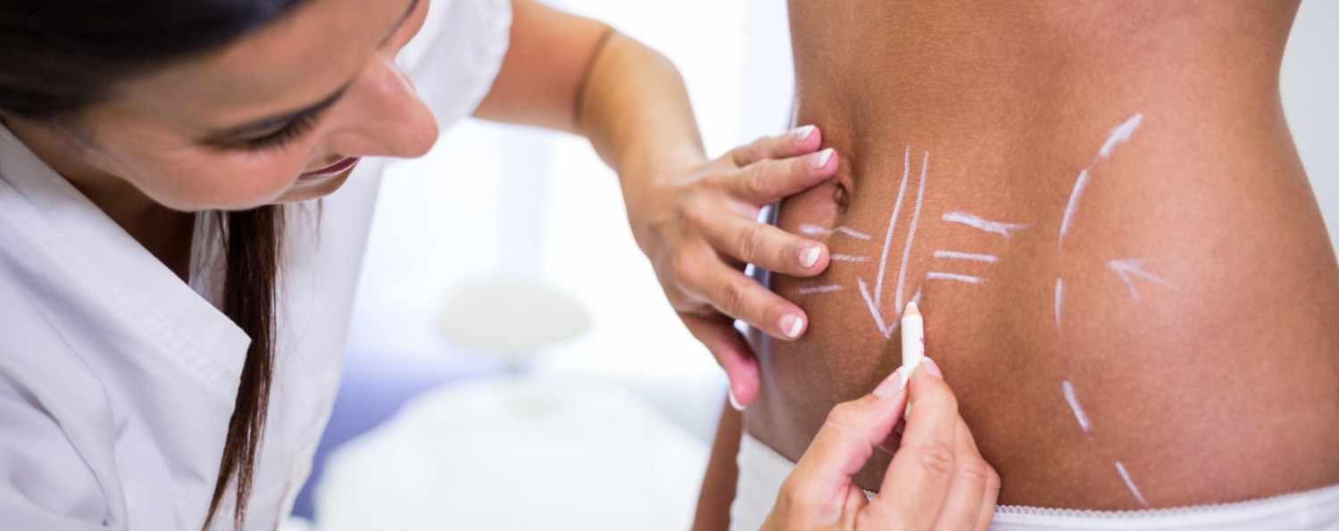Do I Need Liposuction Or A Tummy Tuck?